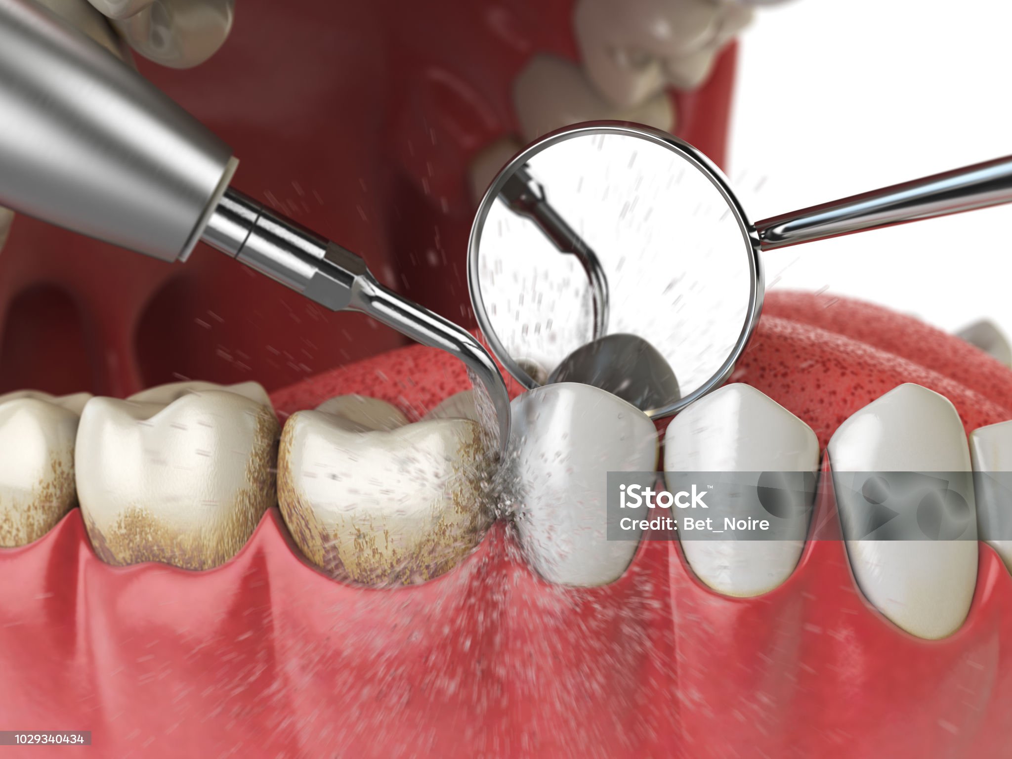 Before Invisalign treatment