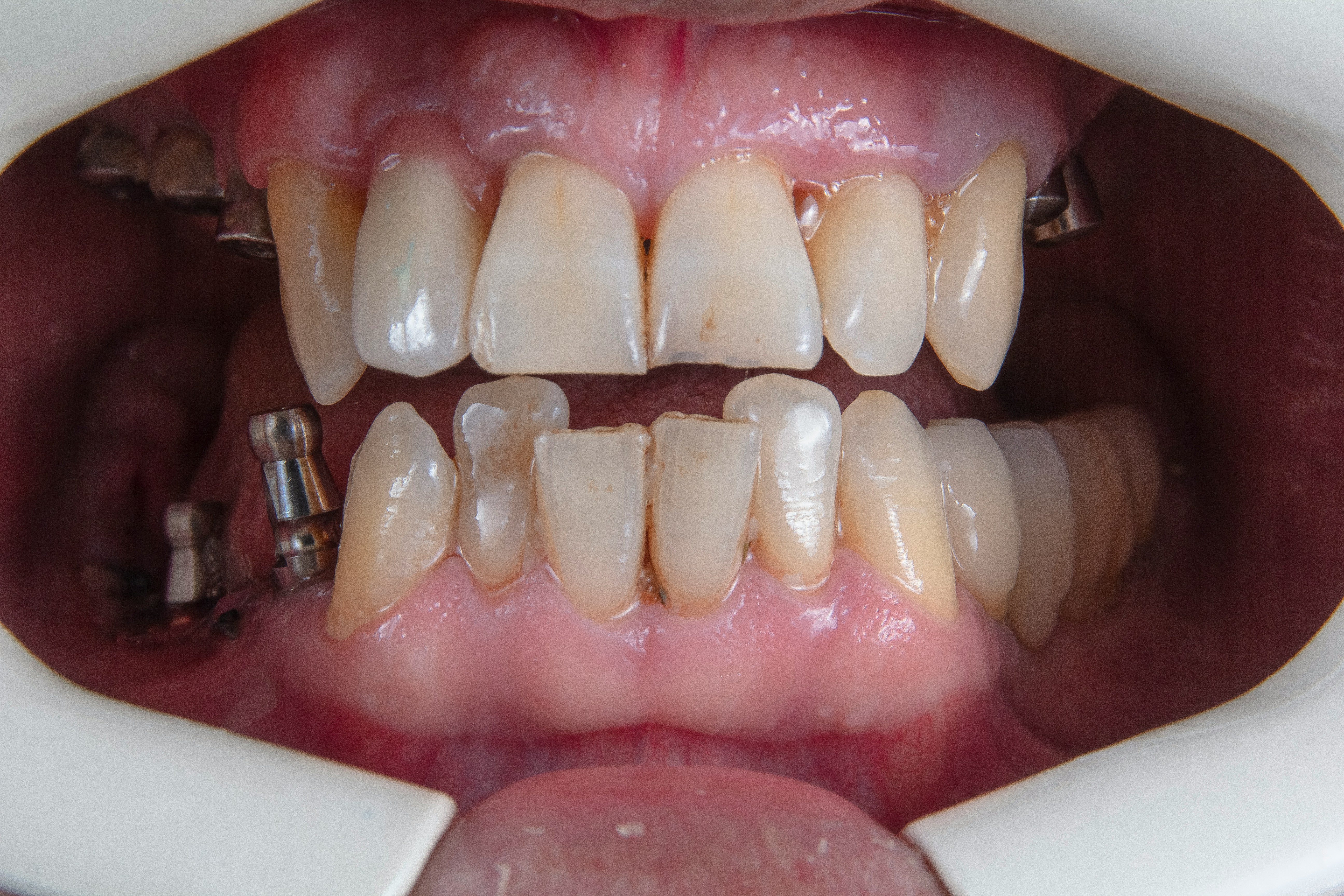 Before dental cleaning and whitening