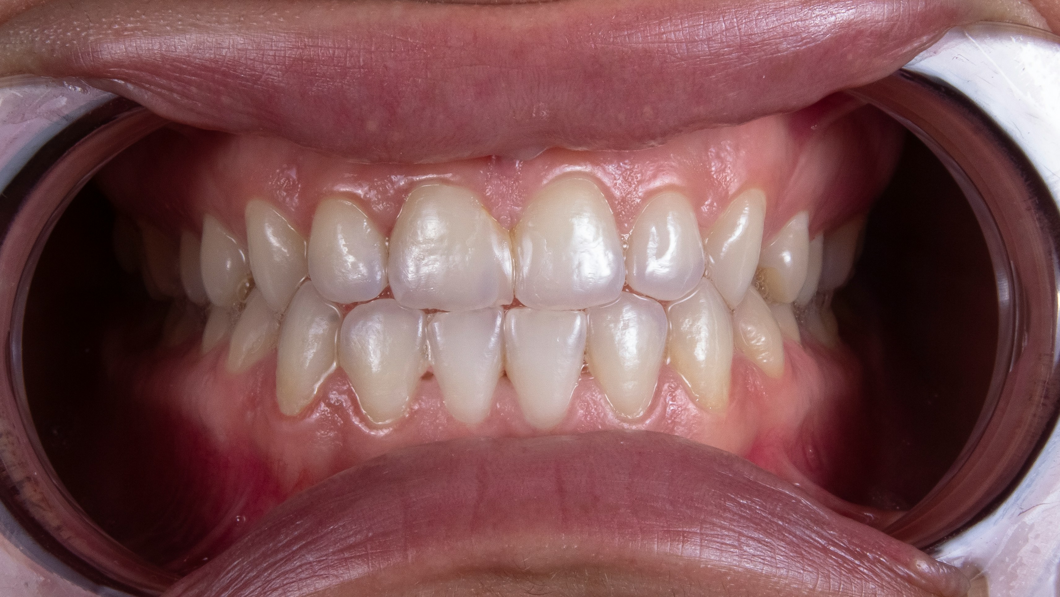 After comprehensive cleaning and whitening treatment
